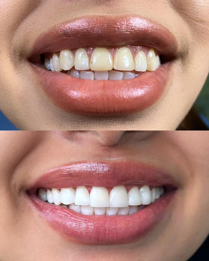 Antes y después de diseño de sonrisa