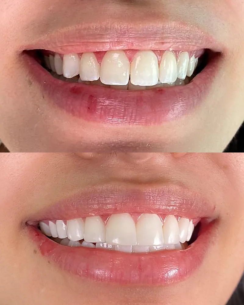 Antes y después de diseño de sonrisa