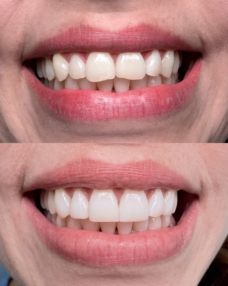 Antes y después de diseño de sonrisa