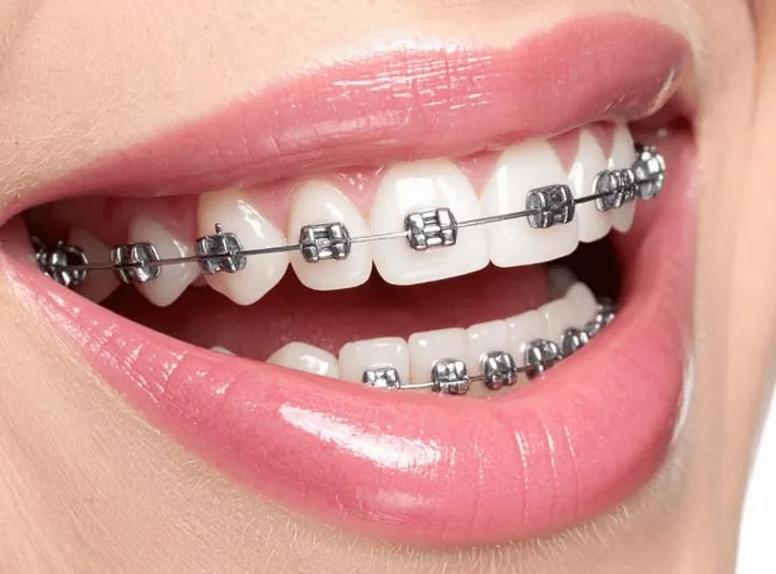 Brackets Estéticos Cerámica o Zafiro