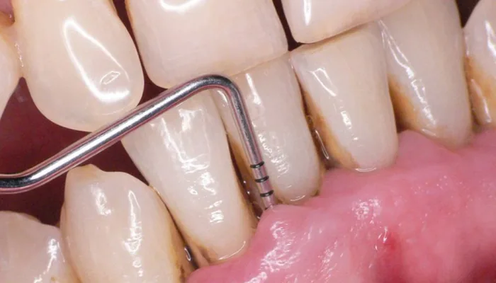 Periodoncia
